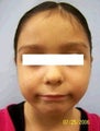 Ear Surgery (Otoplasty)