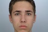 otoplasty