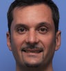 Otoplasty