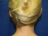 Otoplasty