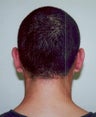 Otoplasty - Bilateral protruding ears