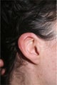 Otoplasty