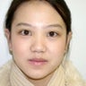 Otoplasty