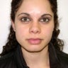Otoplasty