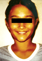 Otoplasty