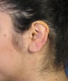 Otoplasty