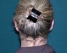 Ear Pinning