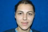 Otoplasty