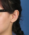 Otoplasty