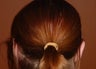 Otoplasty/ear pin back