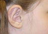Correction protruding ears