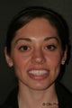 Otoplasty
