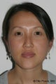 Otoplasty