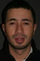 Otoplasty