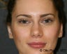 Otoplasty