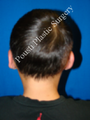 Ear Surgery (Otoplasty)