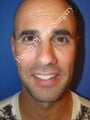 Ear Surgery (Otoplasty)
