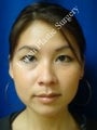 Ear Surgery (Otoplasty)