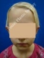 Ear Surgery (Otoplasty)