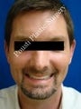 Ear Surgery (Otoplasty)