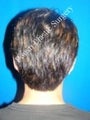 Ear Surgery (Otoplasty)