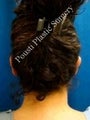 Ear Surgery (Otoplasty)