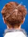 Ear Surgery (Otoplasty)