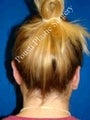 Ear Surgery (Otoplasty)