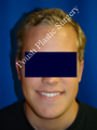 Ear Surgery (Otoplasty)