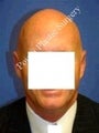 Ear Surgery (Otoplasty)