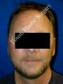 Ear Surgery (Otoplasty)