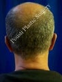 Ear Surgery (Otoplasty)