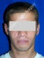 Ear Surgery (Otoplasty)