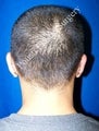 Ear Surgery (Otoplasty)