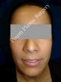 Ear Surgery (Otoplasty)