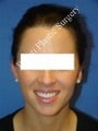 Ear Surgery (Otoplasty)