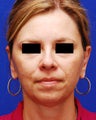 Otoplasty