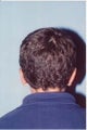 Ear Reshaping