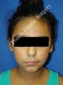 Ear Surgery (Otoplasty)