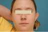 Ear Surgery (Otoplasty)