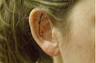 Ear Surgery (Otoplasty)