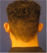 Otoplasty