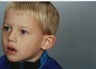 Otoplasty