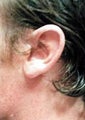 Otoplasty Photo