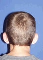 Ear Surgery (Otoplasty)