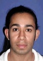Ear Surgery (Otoplasty)