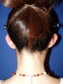 Ear Surgery (Otoplasty)