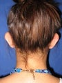 Ear Surgery (Otoplasty)