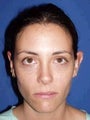 Ear Surgery (Otoplasty)