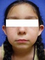 Ear Surgery (Otoplasty)